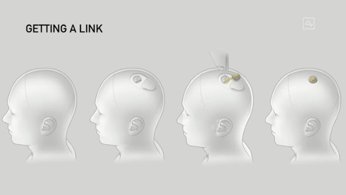 Neuralink на Мъск имплантирала мозъчен чип на човек